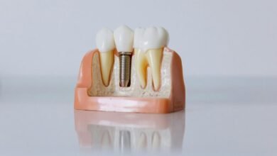 dental implants in hungary
